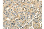 The image on the left is immunohistochemistry of paraffin-embedded Human liver cancer tissue using CSB-PA615999(CD70  Antibody) at dilution 1/35, on the right is treated with synthetic peptide. (Original magnification: 