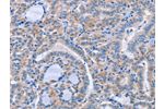 The image on the left is immunohistochemistry of paraffin-embedded Human thyroid cancer tissue using CSB-PA616030(CD36 Antibody) at dilution 1/60, on the right is treated with synthetic peptide. (Original magnification: 