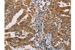 The image on the left is immunohistochemistry of paraffin-embedded Human gastic cancer tissue using CSB-PA616041(ACY1 Antibody) at dilution 1/25, on the right is treated with fusion protein. (Original magnification: 
