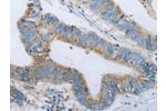 The image on the left is immunohistochemistry of paraffin-embedded Human colon cancer tissue using CSB-PA616184(BDNF Antibody) at dilution 1/20, on the right is treated with fusion protein. (Original magnification: 