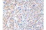 The image on the left is immunohistochemistry of paraffin-embedded Human breast cancer tissue using CSB-PA616530(ADAM15 Antibody) at dilution 1/40, on the right is treated with fusion protein. (Original magnification: 