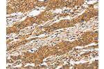 The image on the left is immunohistochemistry of paraffin-embedded Human gastic cancer tissue using CSB-PA616669(CD22 Antibody) at dilution 1/50, on the right is treated with fusion protein. (Original magnification: 