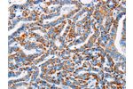 The image on the left is immunohistochemistry of paraffin-embedded Human thyroid cancer tissue using CSB-PA617446(ALG2 Antibody) at dilution 1/20, on the right is treated with fusion protein. (Original magnification: 