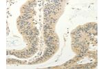 The image on the left is immunohistochemistry of paraffin-embedded Human colon cancer tissue using CSB-PA617545(FZD8 Antibody) at dilution 1/30, on the right is treated with synthetic peptide. (Original magnification: 