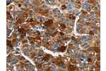 The image on the left is immunohistochemistry of paraffin-embedded Human liver cancer tissue using CSB-PA617569(ARMCX2 Antibody) at dilution 1/40, on the right is treated with fusion protein. (Original magnification: 