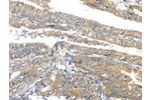 The image on the left is immunohistochemistry of paraffin-embedded Human esophagus cancer tissue using CSB-PA617669(AKT2 Antibody) at dilution 1/40, on the right is treated with synthetic peptide. (Original magnification: 
