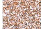The image on the left is immunohistochemistry of paraffin-embedded Human thyroid cancer tissue using CSB-PA617734(GABRG2 Antibody) at dilution 1/20, on the right is treated with synthetic peptide. (Original magnification: 