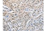 The image on the left is immunohistochemistry of paraffin-embedded Human lung cancer tissue using CSB-PA617763(CDC27 Antibody) at dilution 1/50, on the right is treated with fusion protein. (Original magnification: 