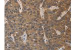 The image on the left is immunohistochemistry of paraffin-embedded Human liver cancer tissue using CSB-PA617990(DEGS1 Antibody) at dilution 1/40, on the right is treated with fusion protein. (Original magnification: 