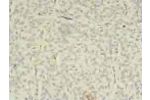 Immunohistochemistry of paraffin-embedded human breast cancer using CSB-PA618004LA01HU at dilution of 1:100