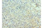 Immunohistochemistry of paraffin-embedded human breast cancer using CSB-PA618753ESR1HU at dilution 1:100