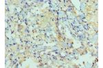 Immunohistochemistry of paraffin-embedded human lung cancer using CSB-PA618774ESR2HU at dilution 1:100