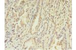 Immunohistochemistry of paraffin-embedded human lung cancer using CSB-PA619871LA01HU at dilution 1:100