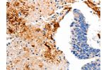 The image on the left is immunohistochemistry of paraffin-embedded Human colon cancer tissue using CSB-PA619982(CCNC Antibody) at dilution 1/15, on the right is treated with fusion protein. (Original magnification: 