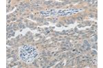 The image on the left is immunohistochemistry of paraffin-embedded Human ovarian cancer tissue using CSB-PA620124(PIWIL2 Antibody) at dilution 1/20, on the right is treated with synthetic peptide. (Original magnification: 