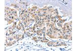 The image on the left is immunohistochemistry of paraffin-embedded Human breast cancer tissue using CSB-PA620593(APOBEC3D Antibody) at dilution 1/80, on the right is treated with synthetic peptide. (Original magnification: 