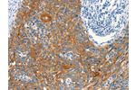 The image on the left is immunohistochemistry of paraffin-embedded Human cervical cancer tissue using CSB-PA620636(ARFGEF2 Antibody) at dilution 1/25, on the right is treated with synthetic peptide. (Original magnification: 