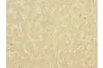 Immunohistochemistry of paraffin-embedded human liver cancer CSB-PA621686EA01HU at dilution 1:100