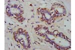 IHC image of CSB-PA621696LA01HU diluted at 1:300 and staining in paraffin-embedded human breast cancer performed on a Leica BondTM system. After dewaxing and hydration, antigen retrieval was mediated by high pressure in a citrate buffer (pH 6.0). Section 