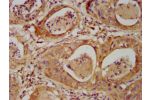 IHC image of CSB-PA621761LA01HU diluted at 1:500 and staining in paraffin-embedded human cervical cancer performed on a Leica BondTM system. After dewaxing and hydration, antigen retrieval was mediated by high pressure in a citrate buffer (pH 6.0). Sectio