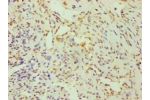 Immunohistochemistry of paraffin-embedded human breast cancer using CSB-PA621957DSR1HU at dilution 1:100