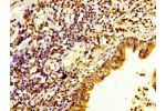 IHC image of CSB-PA621973LA01HU diluted at 1:200 and staining in paraffin-embedded human lung cancer performed on a Leica BondTM system. After dewaxing and hydration, antigen retrieval was mediated by high pressure in a citrate buffer (pH 6.0). Section wa