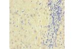 Immunohistochemistry of paraffin-embedded human liver cancer using CSB-PA621974HA01HU at dilution 1:100