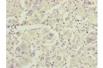 Immunohistochemistry of paraffin-embedded human liver cancer using CSB-PA621975ESR1HU at dilution of 1:100