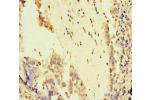 Immunohistochemistry of paraffin-embedded human lung cancer using CSB-PA622666LA01HU at dilution of 1:100