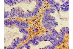 Immunohistochemistry of paraffin-embedded human colon cancer using CSB-PA622752LA01HU at dilution of 1:100
