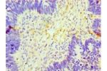 Immunohistochemistry of paraffin-embedded human ovarian cancer using CSB-PA622767LA01HU at dilution 1:100