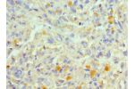 Immunohistochemistry of paraffin-embedded human melanoma using CSB-PA623788ESR1HU at dilution 1:100
