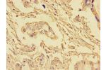 Immunohistochemistry of paraffin-embedded human pancreatic cancer tissue using CSB-PA623815LA01HU at dilution of 1:100