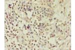 Immunohistochemistry of paraffin-embedded human breast cancer using CSB-PA623829ESR1HU at dilution 1:100