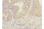 Immunohistochemistry of paraffin-embedded human prostate cancer using CSB-PA623910ESR1HU at dilution 1:100