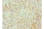 Immunohistochemistry of paraffin-embedded human breast cancer using CSB-PA623920ESR1HU at dilution 1:100