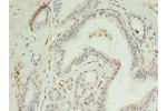 Immunohistochemistry of paraffin-embedded human breast cancer using CSB-PA623930LA01HU at dilution of 1:100