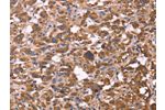 The image on the left is immunohistochemistry of paraffin-embedded Human thyroid cancer tissue using CSB-PA623964(FBXW7 Antibody) at dilution 1/30, on the right is treated with fusion protein. (Original magnification: 