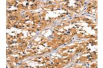 The image on the left is immunohistochemistry of paraffin-embedded Human thyroid cancer tissue using CSB-PA624049(ALOX15 Antibody) at dilution 1/60, on the right is treated with synthetic peptide. (Original magnification: 