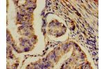 Immunohistochemistry of paraffin-embedded human endometrial cancer using CSB-PA624122LA01HU at dilution of 1:100