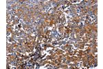 The image on the left is immunohistochemistry of paraffin-embedded Human ovarian cancer tissue using CSB-PA625538(DUSP6 Antibody) at dilution 1/25, on the right is treated with fusion protein. (Original magnification: 