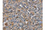 The image on the left is immunohistochemistry of paraffin-embedded Human liver cancer tissue using CSB-PA632606(DNMT3A Antibody) at dilution 1/50, on the right is treated with fusion protein. (Original magnification: 