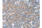The image on the left is immunohistochemistry of paraffin-embedded Human liver cancer tissue using CSB-PA634200(CHAC1 Antibody) at dilution 1/40, on the right is treated with fusion protein. (Original magnification: 