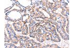 The image on the left is immunohistochemistry of paraffin-embedded Human thyroid cancer tissue using CSB-PA634270(ADRBK1  Antibody) at dilution 1/87, on the right is treated with synthetic peptide. (Original magnification: 