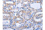 The image on the left is immunohistochemistry of paraffin-embedded Human thyroid cancer tissue using CSB-PA634274(GFER Antibody) at dilution 1/50, on the right is treated with fusion protein. (Original magnification: 