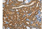 The image on the left is immunohistochemistry of paraffin-embedded Human thyroid cancer tissue using CSB-PA637350(EPHB3 Antibody) at dilution 1/40, on the right is treated with synthetic peptide. (Original magnification: 