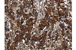The image on the left is immunohistochemistry of paraffin-embedded Human liver cancer tissue using CSB-PA640140(GLIPR1 Antibody) at dilution 1/60, on the right is treated with fusion protein. (Original magnification: 
