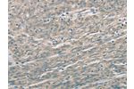 The image on the left is immunohistochemistry of paraffin-embedded Human esophagus cancer tissue using CSB-PA640379(EDA2R Antibody) at dilution 1/60, on the right is treated with fusion protein. (Original magnification: 