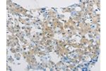 The image on the left is immunohistochemistry of paraffin-embedded Human breast cancer tissue using CSB-PA640573(CLEC4C Antibody) at dilution 1/70, on the right is treated with synthetic peptide. (Original magnification: 