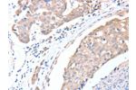 The image on the left is immunohistochemistry of paraffin-embedded Human breast cancer tissue using CSB-PA641289(ACTL8 Antibody) at dilution 1/15, on the right is treated with fusion protein. (Original magnification: 